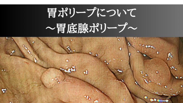 胃ポリープについて ～胃底腺ポリープ～