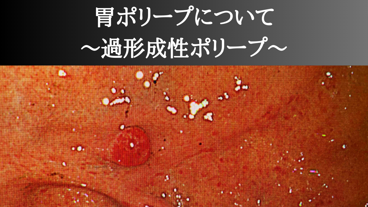 胃ポリープにはどんな種類があるの?